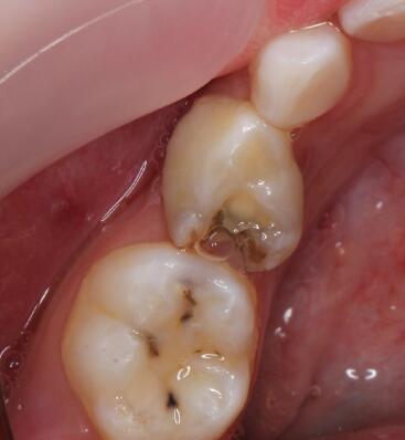 儿童乳牙龋齿不宜轻视.jpg