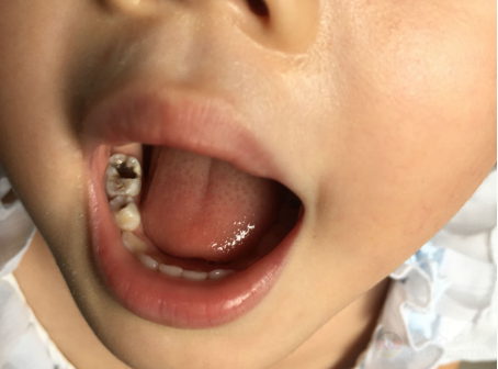 儿童虫牙 蛀牙图片.png