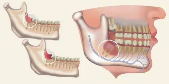 智齿危害.jpg