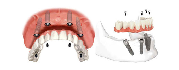 半口牙缺失种植牙首先All-on-4种植技术.jpg