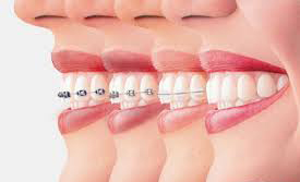 四大牙齿矫正方法.jpg
