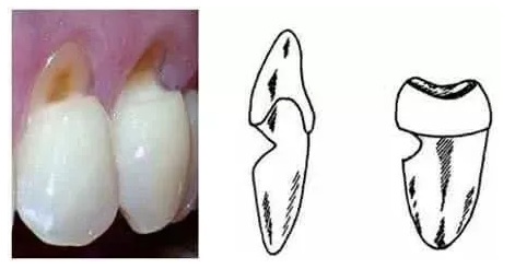 牙齿楔缺案例图片.png