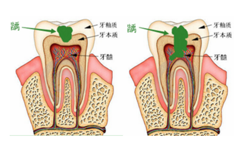 牙齿虫洞逐渐变大.png