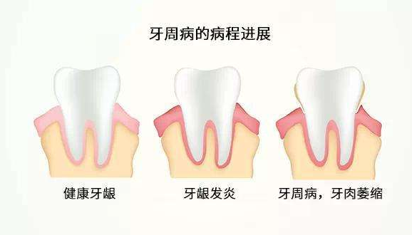 牙周病的病程进展