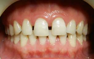 　牙缝大的形成原因是什么