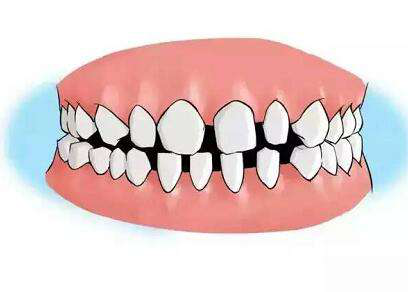 为何有的人牙齿会有缝隙.png