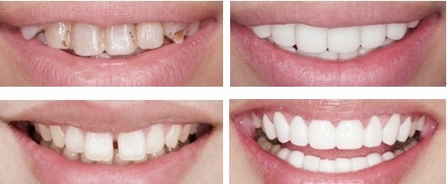 牙齿美容修复前后对比.jpg