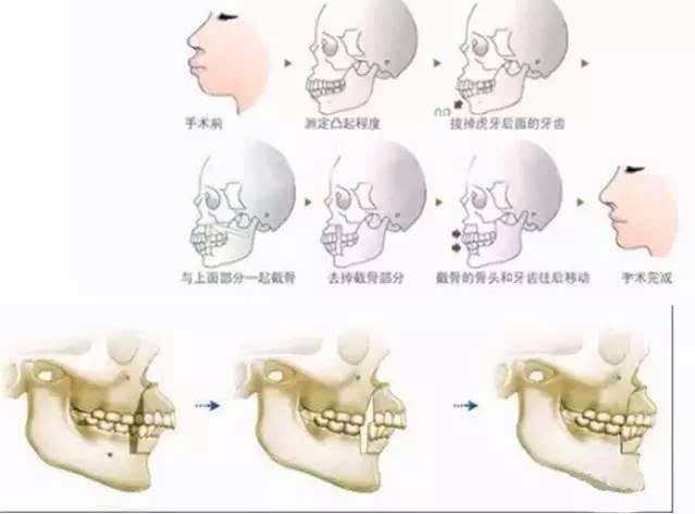 口腔专家表示,骨性地包天是颌面部骨骼发育异常造成的上