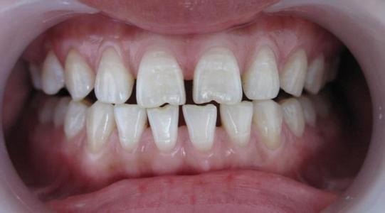 牙齿稀疏有哪些不良影响