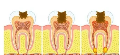 龋齿如何快速补牙