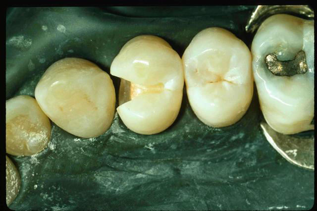 首页 牙齿修复 牙齿缺损  齿尖斜面:正常情况下,当牙齿受力时,由于齿
