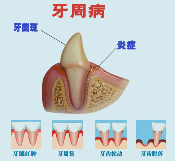 牙周病怎么治疗呢?