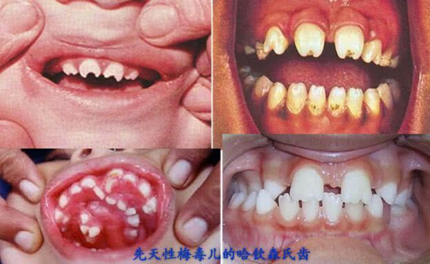 什么是先天性梅毒牙